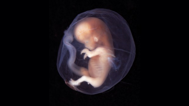 web-fetus-embryo-9-10-weeks-lunar-caustic-cc