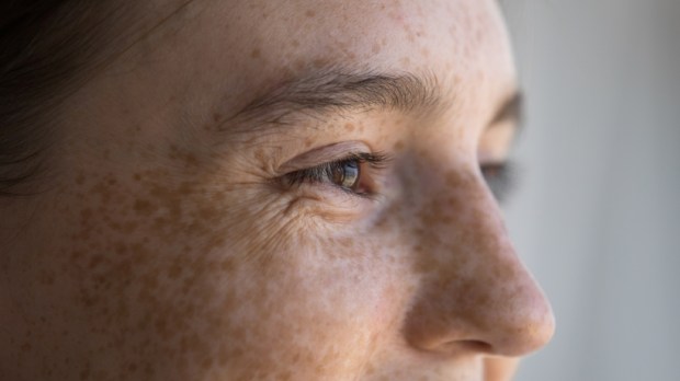 freckled young woman